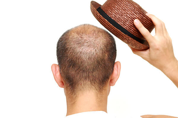 自毛植毛術後の後頭部はどうなる？どれぐらいで生えてくる？