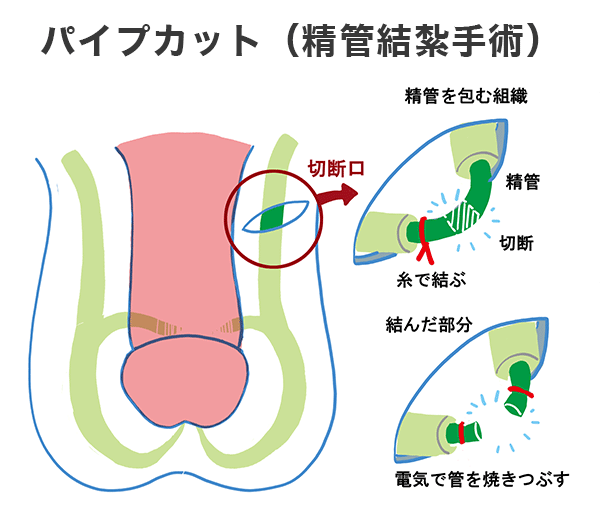 さく 手術 らん かん けっ