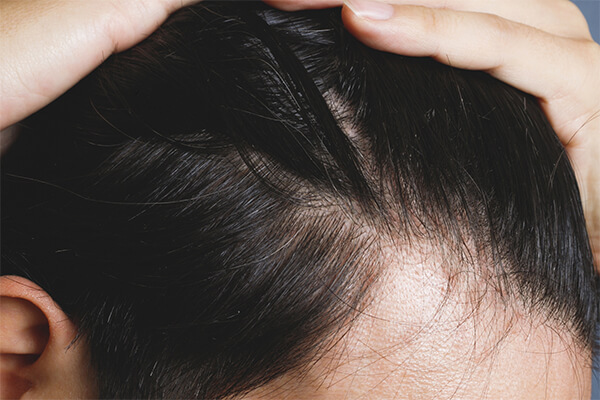 ヘアラインの植毛で矯正するときのポイント きれいな生え際に Dantes ダンテス 男性向け医療 健康情報サイト