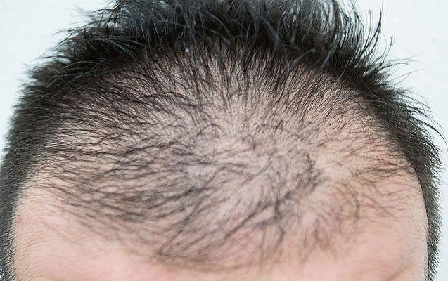 頭皮の乾燥はハゲる可能性が 薄毛対策と原因 Dantes ダンテス 男性向け医療 健康情報サイト